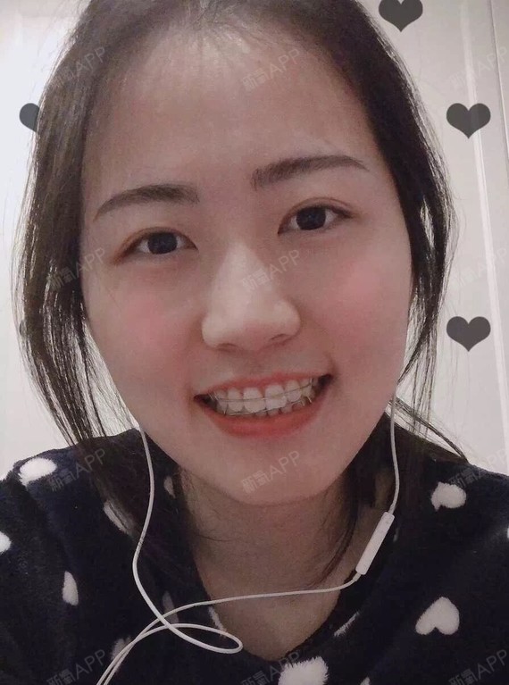摘牙套最后这张戴的哈氏保持器熟悉的钢丝让我有一种亲_圈子-新氧美容