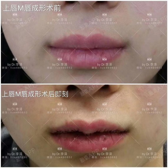 经历了拍照消毒终于上手术台了 术前李医生很细心的用尺子画线 重点