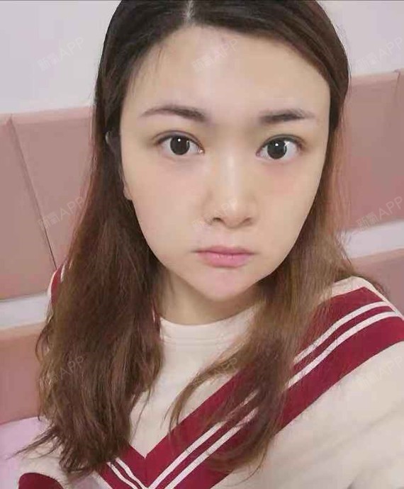 calista_光纤溶脂瘦脸第7天美瘦脸记没打10天了丽日效果针图片