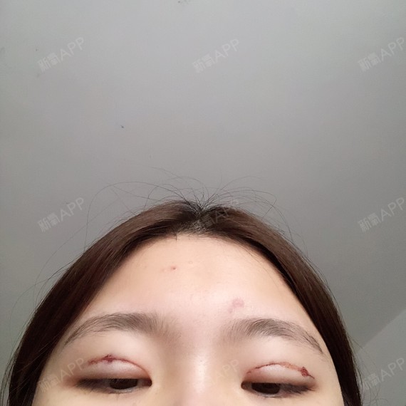 埋线双眼皮