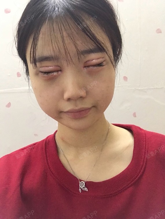 眼部综合