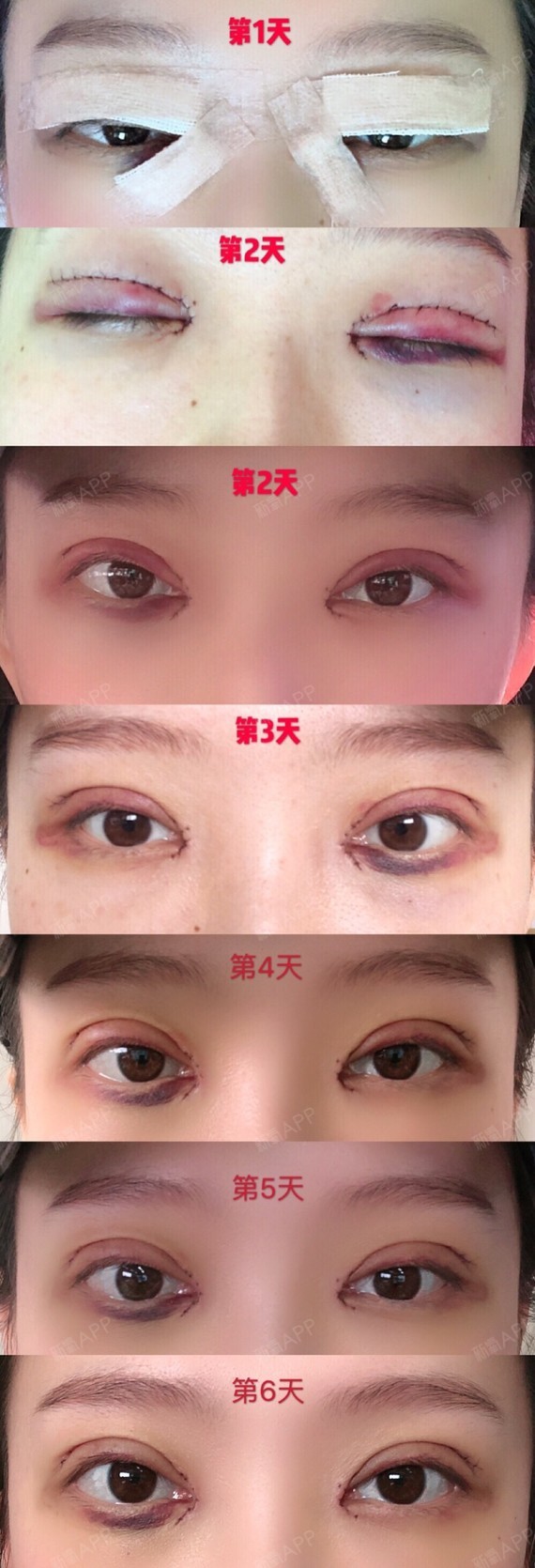 [双眼皮 开眼角 去皮去脂]089969♀1508