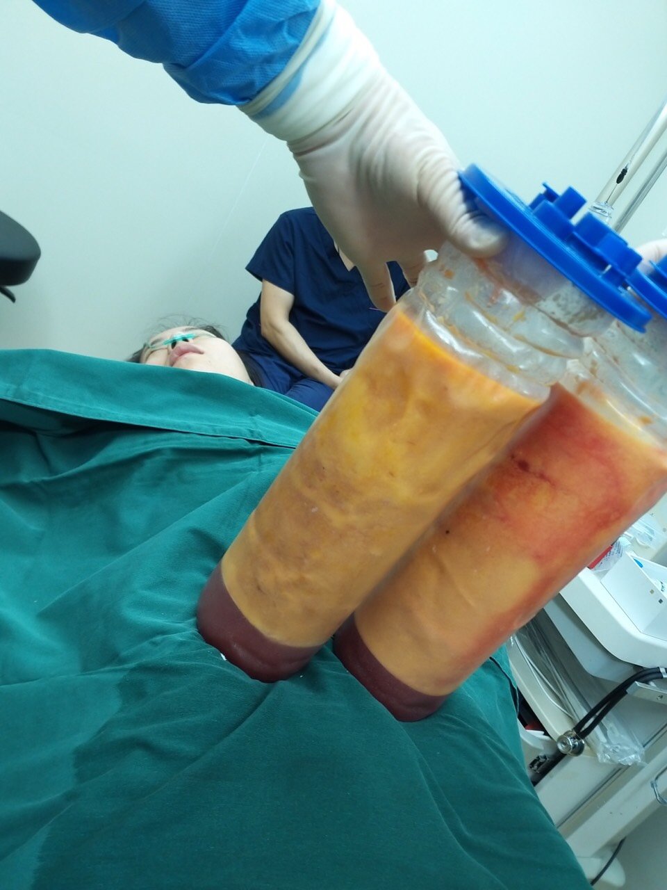 超声溶脂瘦腰部第0天