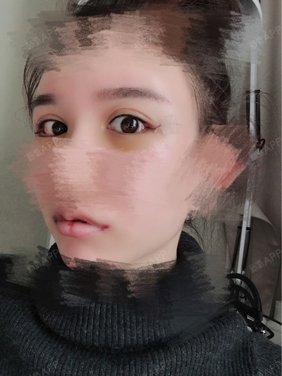 这两天脸过敏,所以没有更新日记,眼睛下面有淤青,嘴巴上已经结痂了