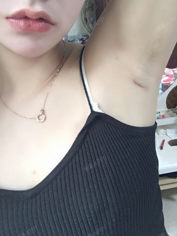 假体隆胸好不好_效果图_叁小妹假体隆胸术后第283天