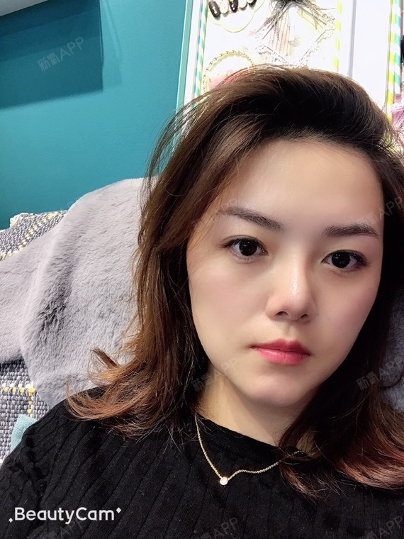 有点点小凹点越来越不明显了