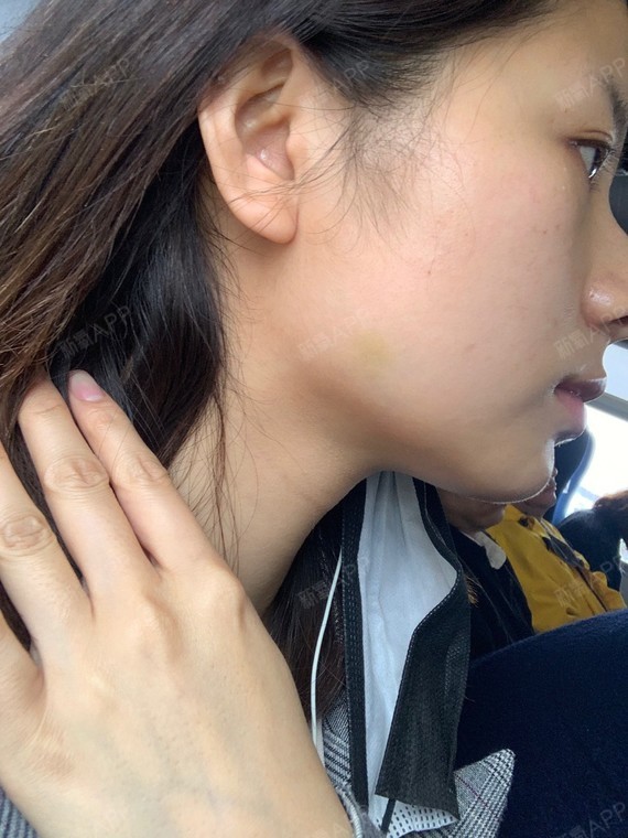 今天右脸有淤青啊