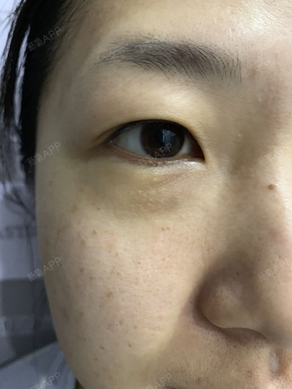 我属于重度提肌无力了吧,上眼皮脂肪也非常厚,这次_圈子-新氧美容