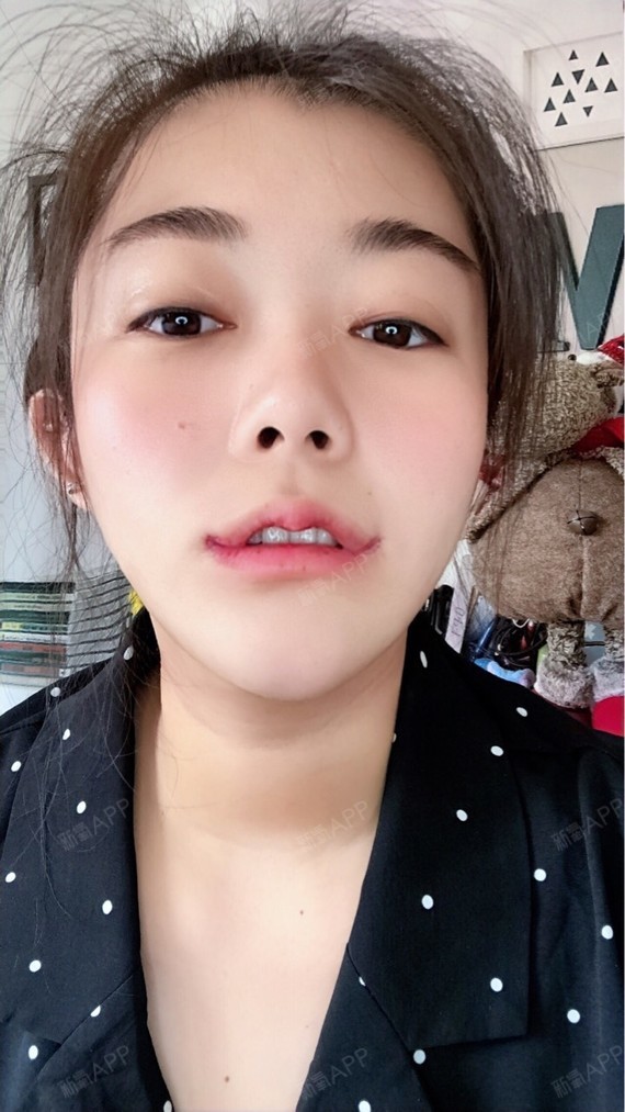 m唇手术