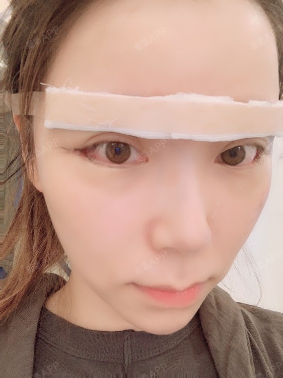 开外眼角