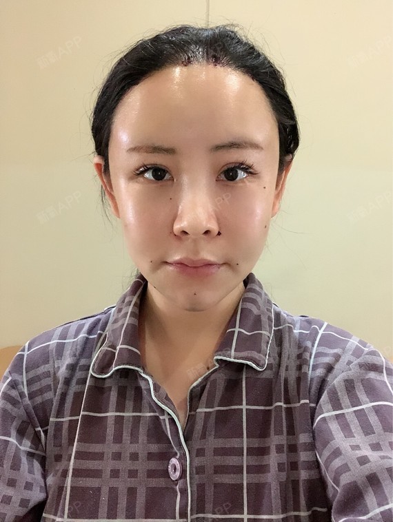 自体脂肪填充额头