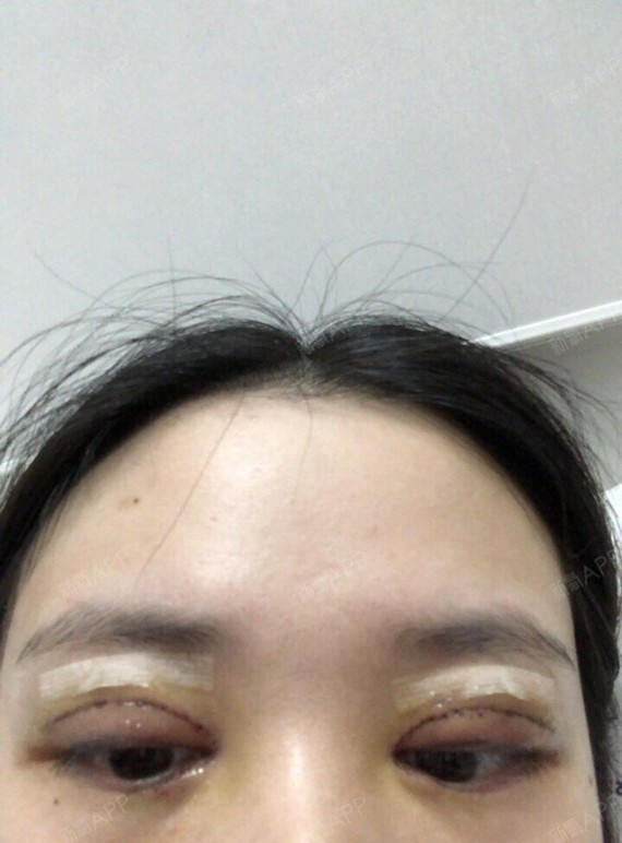 哈喽 我又继续来分享我割双眼皮的感受了 割的当天眼睛都还好 不怎么