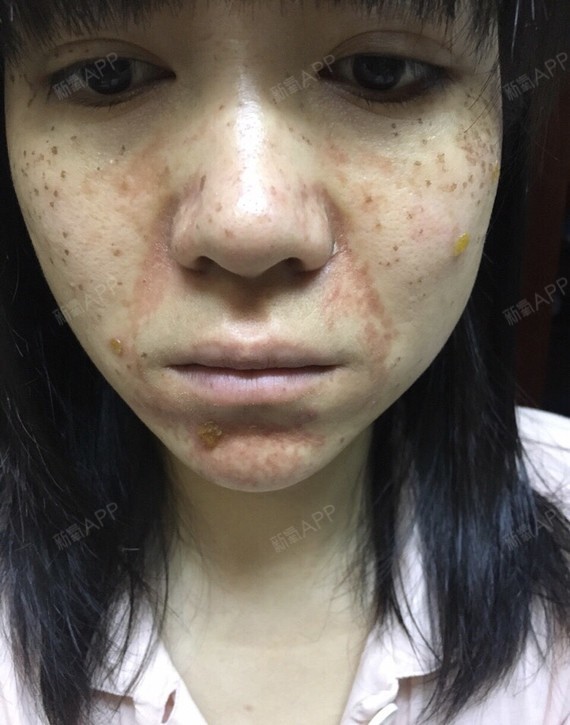 皮秒第三天我的法令纹那里是我对麻药过敏引起的