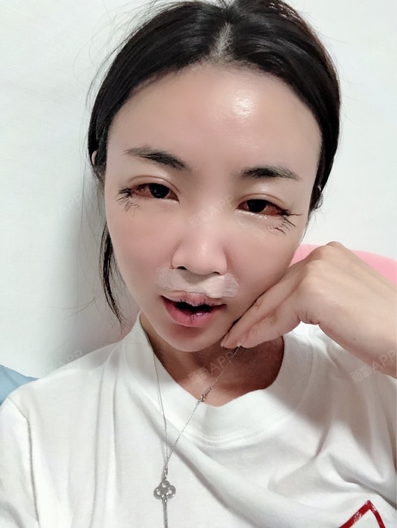 人中缩短术好不好_效果图_linda瑶瑶姐人中缩短术术后