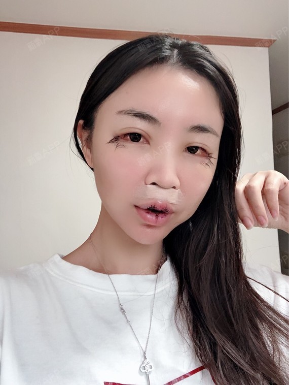 人中缩短术好不好_效果图_linda瑶瑶姐人中缩短术术后