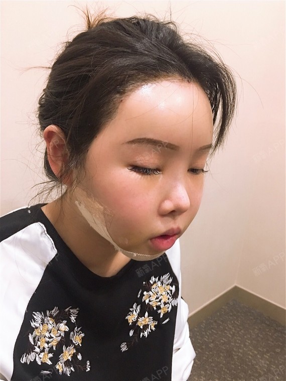 坐标:韩国da整形项目:轮廓三件套(取下巴假体) _圈子