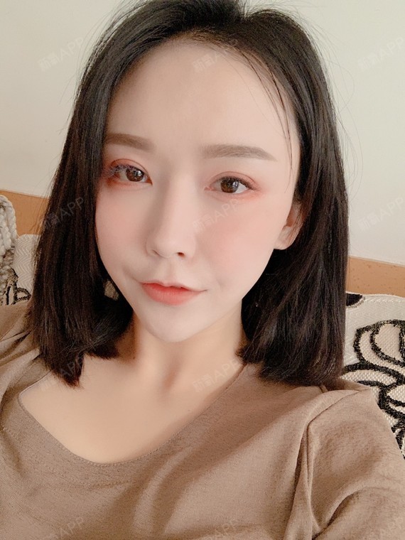 140天 眼角回缩还是比较明显的 所以前期根本不用担心开的大的问题