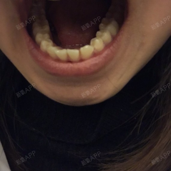 我口腔里面牙垢不多,可以洗掉,但是牙上的黑点,特别是牙缝中间的黑点