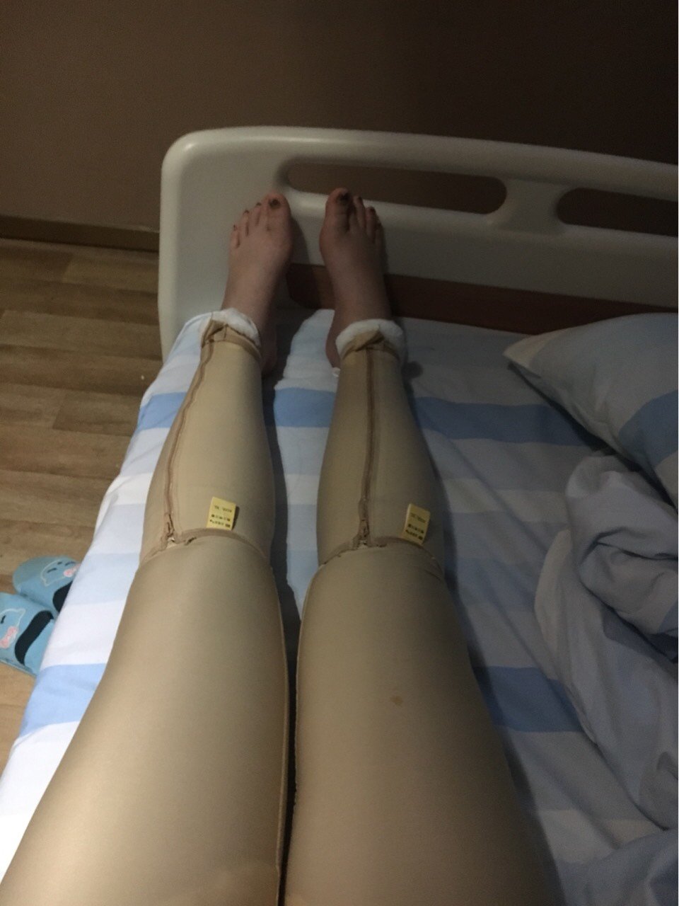射频溶脂瘦大腿第1天