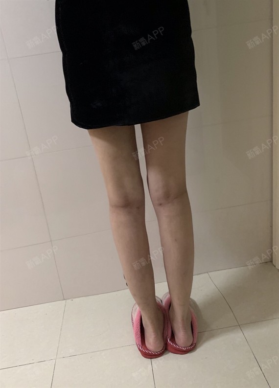 张慧妹妹妹雯雯超声溶脂瘦大腿第136天美丽日记