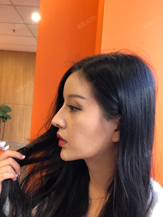 北京取颊脂垫瘦脸好不好_效果图_小仙女呀丶取颊脂垫