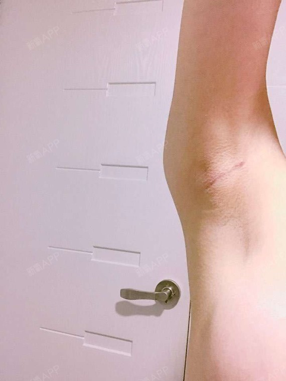 隆胸300cc效果图,假体隆胸700cc真人图片 蓓菈 假体规格: 300cc 身高/体重:163cm/43kg 时间过得很快, 隆胸快