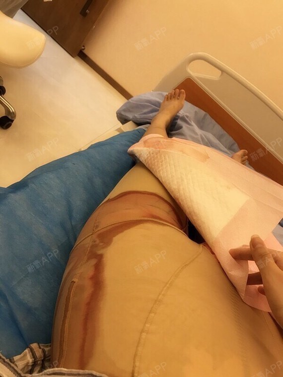 吸脂瘦大腿