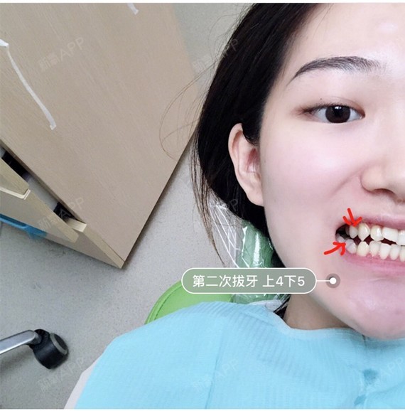 金属自锁牙套开启钢牙妹的模式