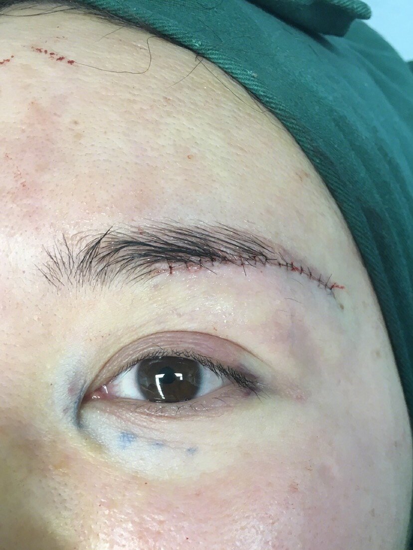 今天是手术的第三天哦切眉手术特别适合年轻时候双眼皮形状很好,但是