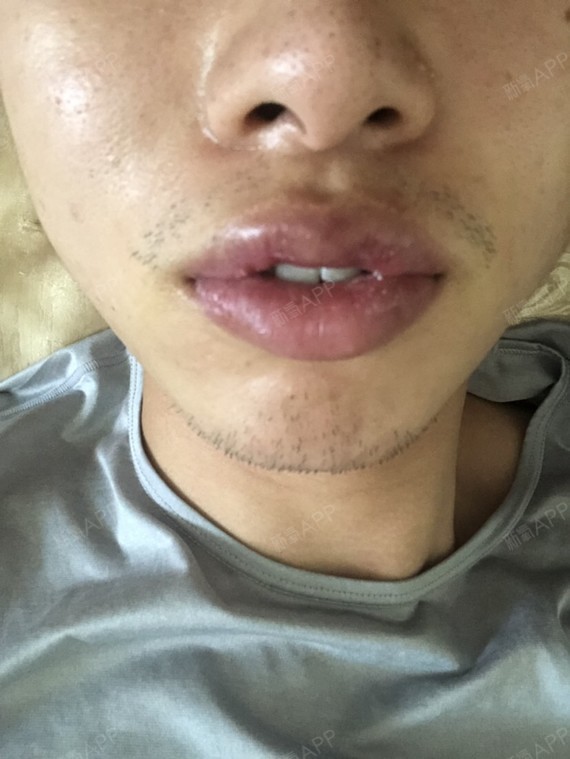 拆线的第三天,左边嘴唇里面有个硬块,导致上嘴唇是歪
