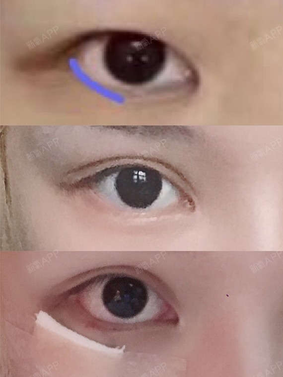 开外眼角