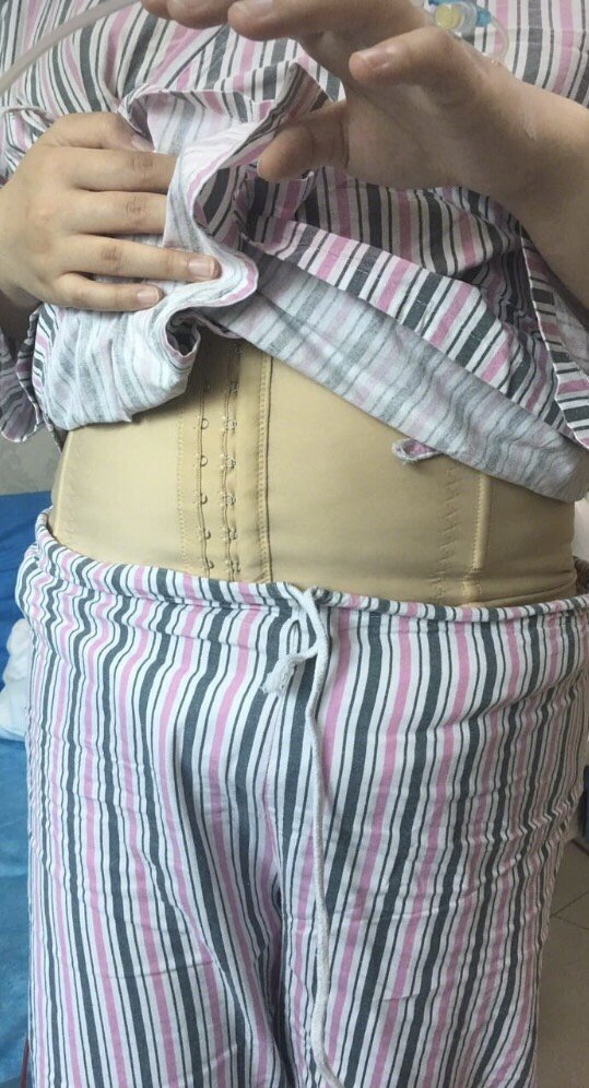吸脂瘦腹部第0天