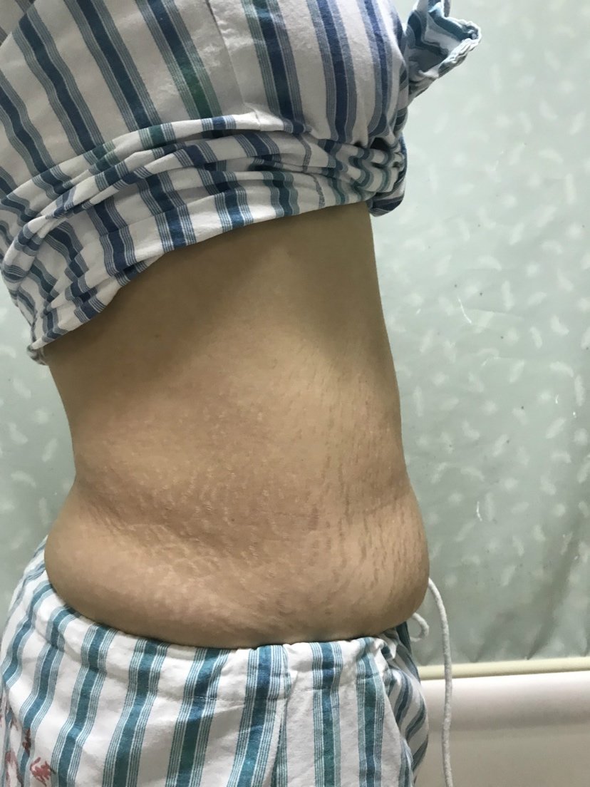 深圳恒生医院医疗美容科腹壁成形术怎么样_恢复过程
