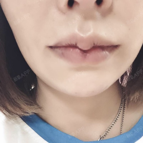 m唇手术