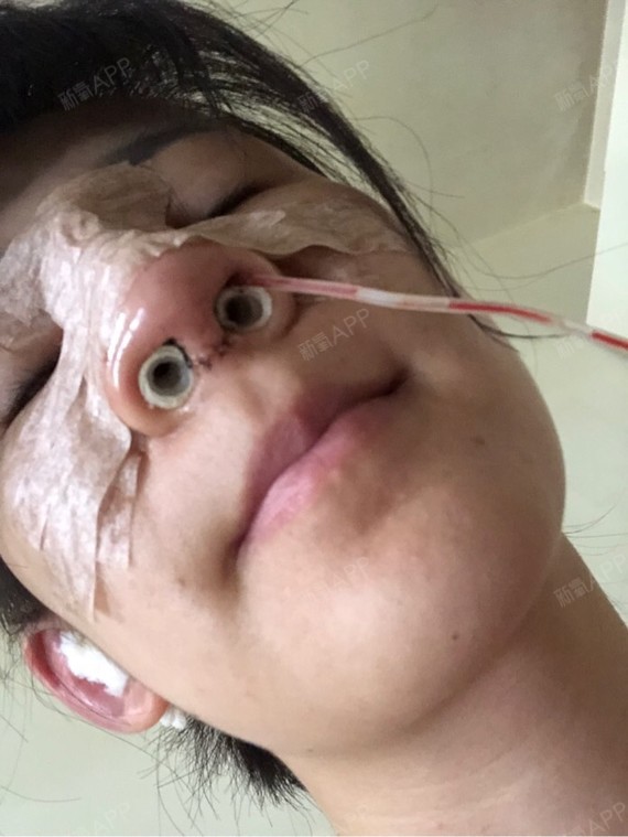 眼睛肿了,鼻子也很肿!上嘴唇也凸了