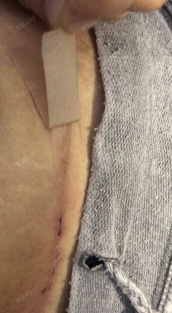 昨天愈合的伤口迫不及待的贴上了美皮护(没有完全闭合