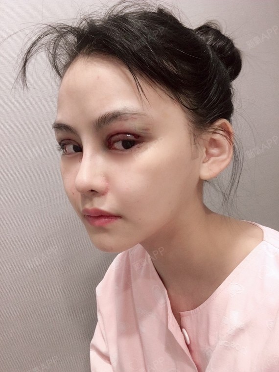开外眼角