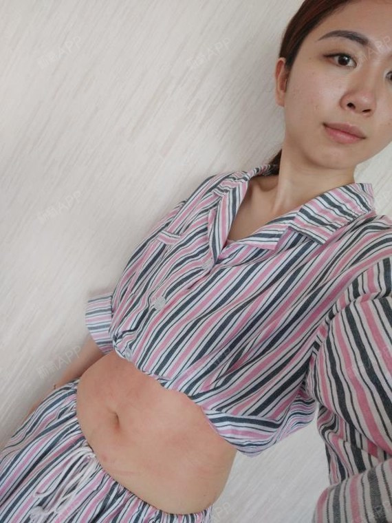 冷冻溶脂瘦腹部