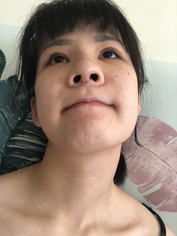 我这脸还是肿得怪怪的,鼻头也肿,鼻孔一大一小!