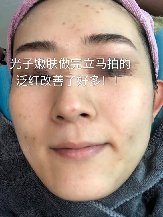 光子嫩肤多久做一次_光子去红血丝多久做一次好_晚期肺癌做光子刀的效果