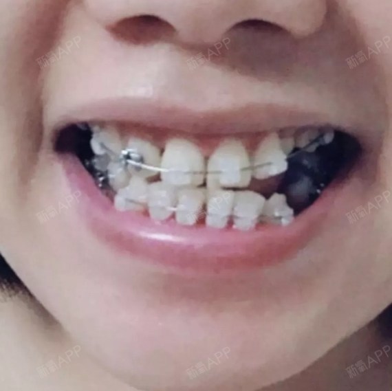 从小牙齿就乱七八糟的,也从来没有想过要矫正.而且我