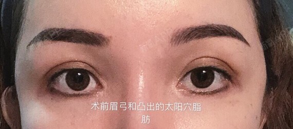 北京东环亦美医疗美容机构# #膨体眉弓/吸太阳穴脂_圈子-新氧美容整形