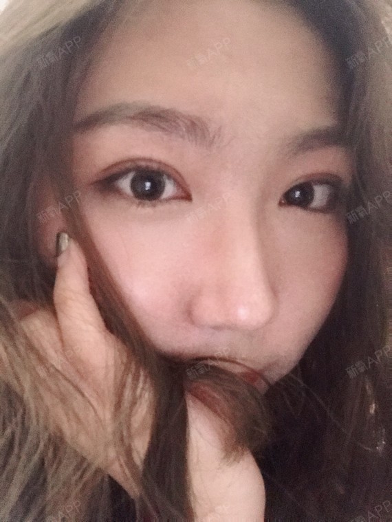 埋线双眼皮好不好_效果图_杉杉有鲤埋线双眼皮术后第7