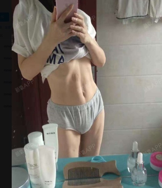 大腿溶脂瘦超声瘦腹部外则图片