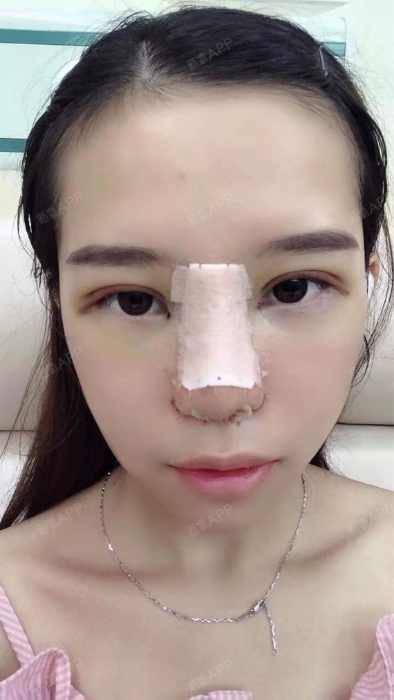 手术缩鼻头