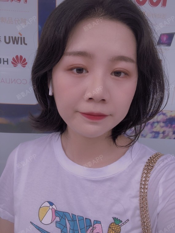 重庆埋线双眼皮好不好_效果图_氧气3t791埋线双眼皮术