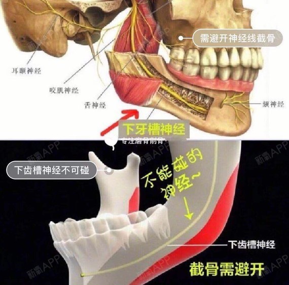 方案查看颧骨颧弓整形术手术轻度疼痛颧骨颧弓降低