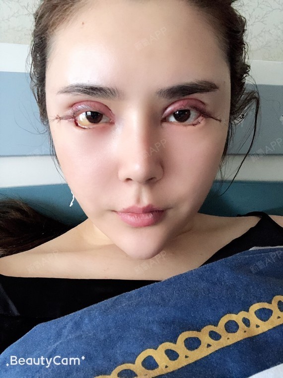 开外眼角