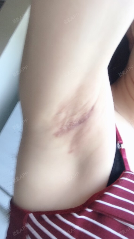 假体隆胸