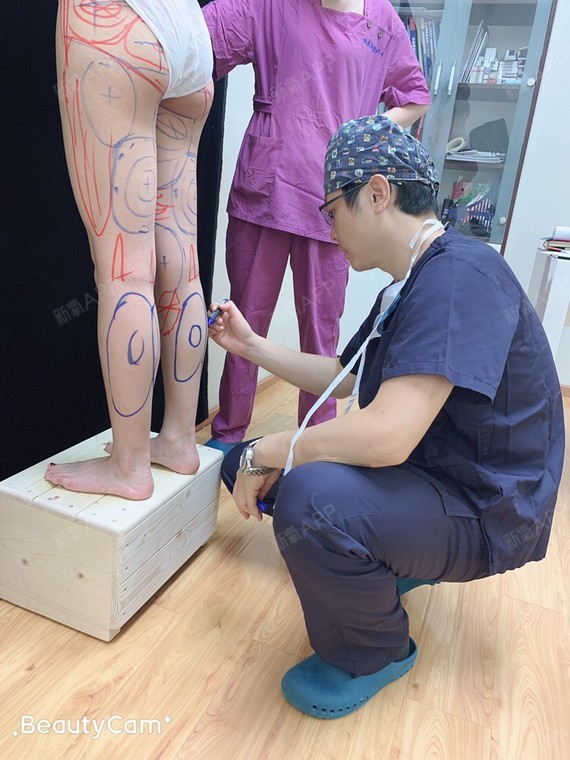 吸脂瘦腹部